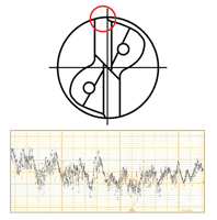 Conventional single margin